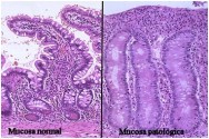 mucosa atrofiada